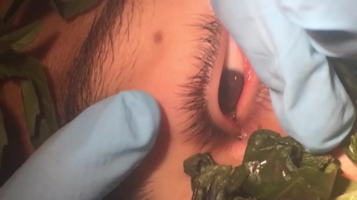 Peru: See WORM removed from boy's eye after ONE MONTH