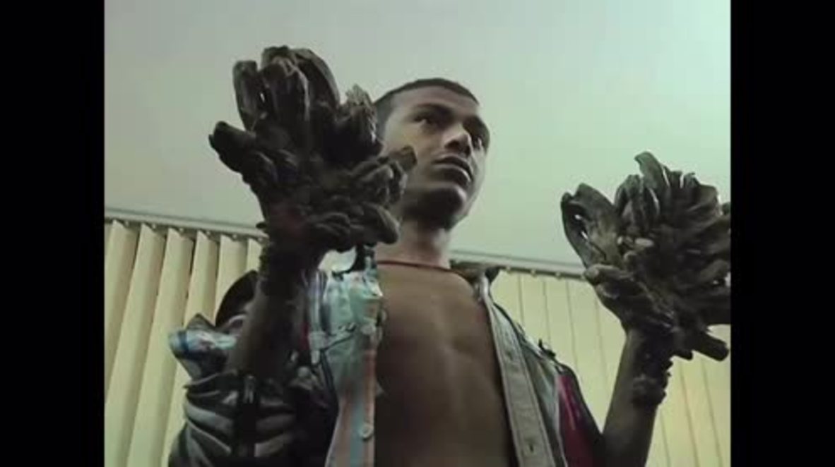 Bangladesh: 'Treeman' to undergo surgery on bark-like warts