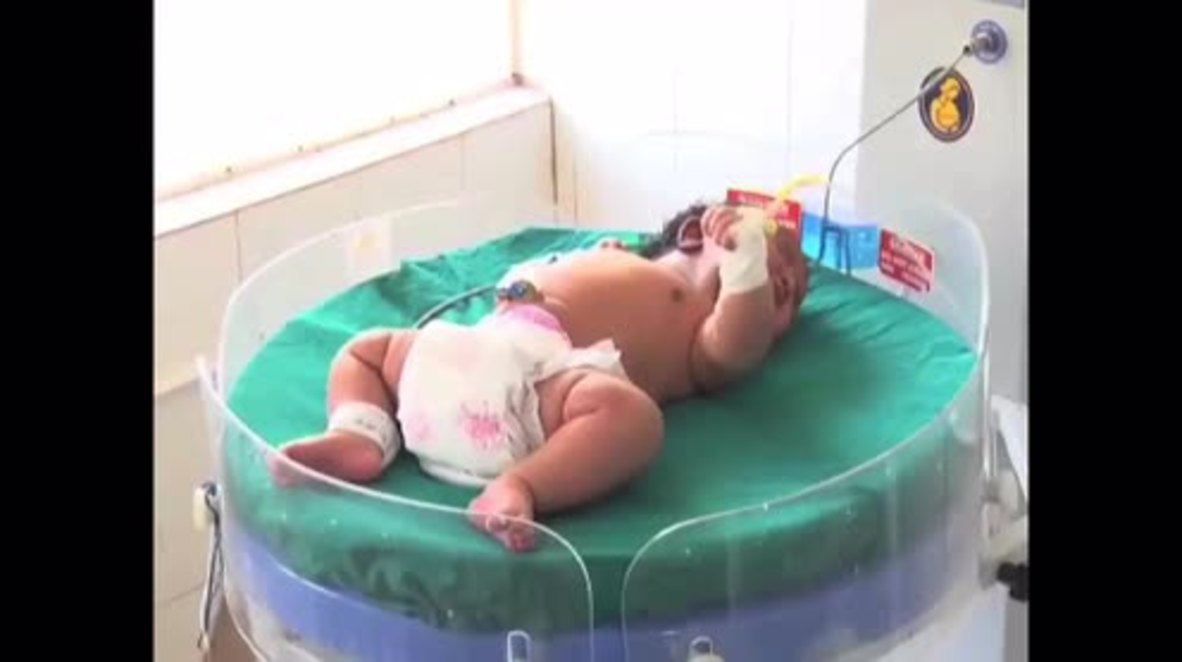 India: World's heaviest ever baby girl born in Hassan