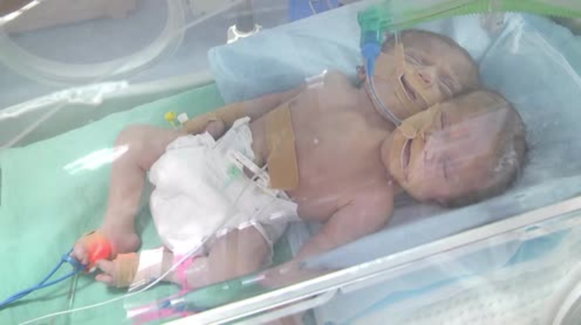 State of Palestine: Conjoined twins with two heads and one body born in Gaza