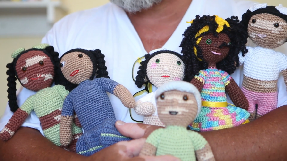 Brazilian grandfather creates vitiligo DOLLS for kids with skin disorder