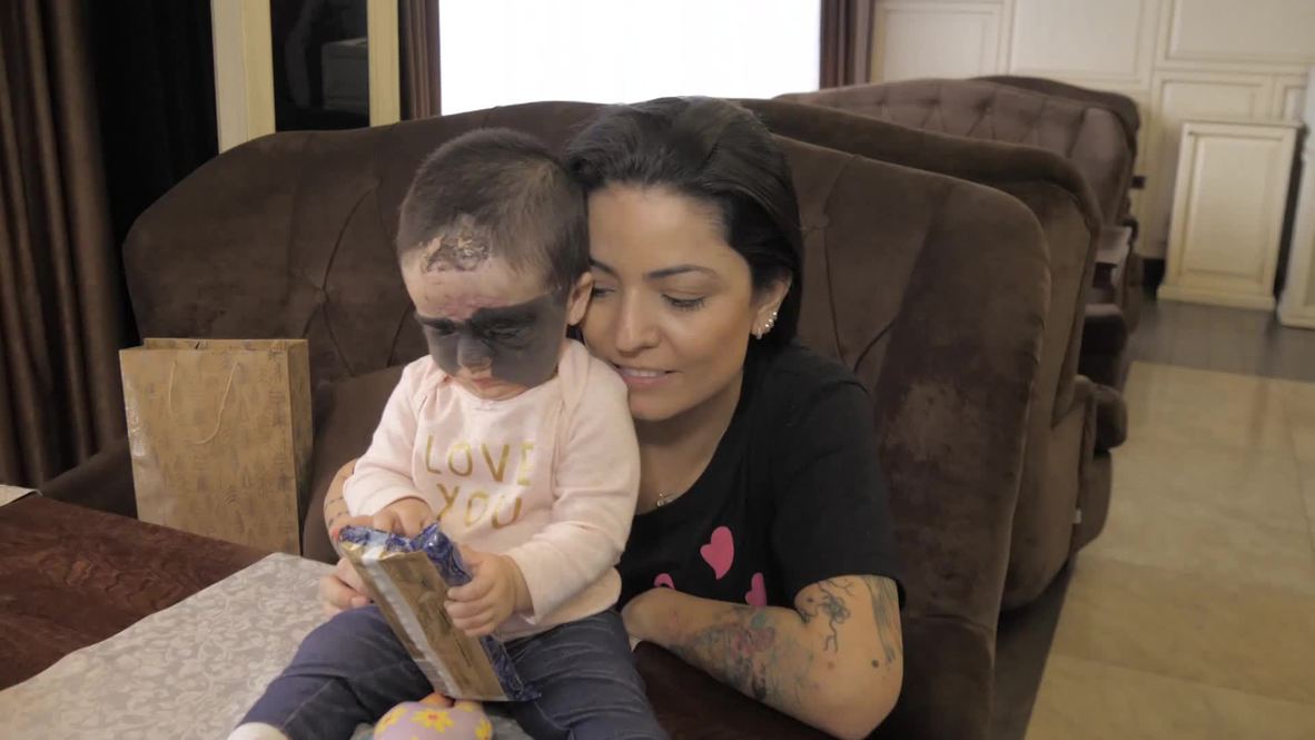 Russia: Mum of Florida baby with 'Batman' birthmark happy with progress of treatment *EXCLUSIVE*
