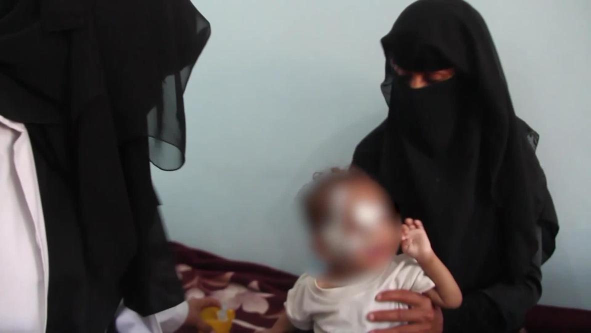 اليمن: اليونيسف تحذر من ارتفاع معدل سوء التغذية الحاد لدى الأطفال في أنحاء مختلفة من البلاد